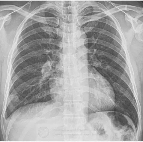 胸壁疼痛的典型特征,临床诊断胸痛是什么意思