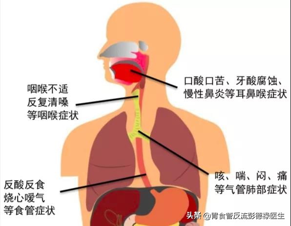 反酸咽喉炎的最佳治疗方法,咽喉反酸打嗝会好些吗