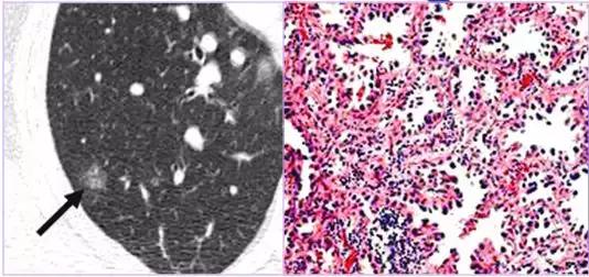 肺部ct十大征象,肺部ct正常图和异常图的区别
