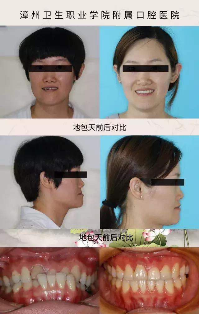 什么叫地包天怎么治疗,什么叫地包天能矫正吗