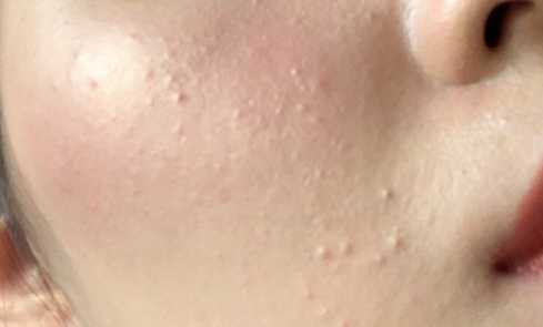 如何分辨痘痘的类型和长痘的原因,如何判断自己长的痘痘是哪种痘痘