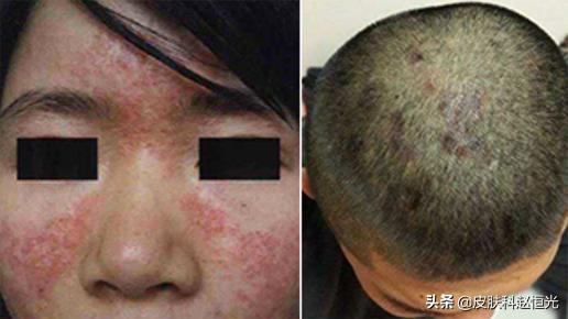 希尔生治疗脂溢性皮炎会反复吗,为什么婴儿脂溢性皮炎会反复发作