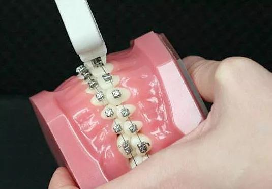 戴牙套遇到最大的牙齿问题,戴牙套必须要知道的事