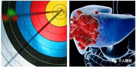 栓塞介入能治疗肝转移瘤吗,结肠癌肝转移介入栓塞治疗