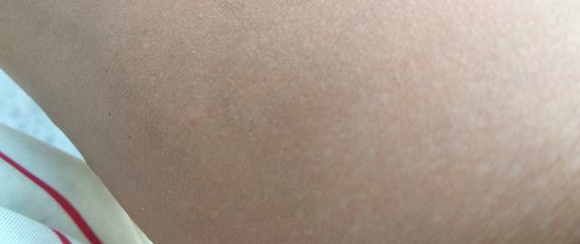 痘痘生长的四个阶段及去除方法,痘痘的防治方法有哪些