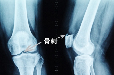 长跑中怎样避免足底筋膜炎,跑步引起的足底筋膜炎的康复训练