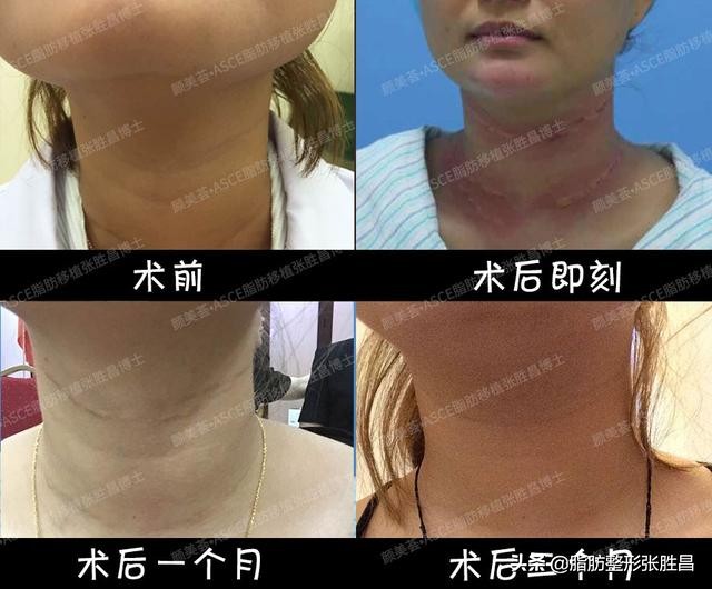 颈纹太多又显老，但常规方法祛除总是不能持久？做这个就可以了