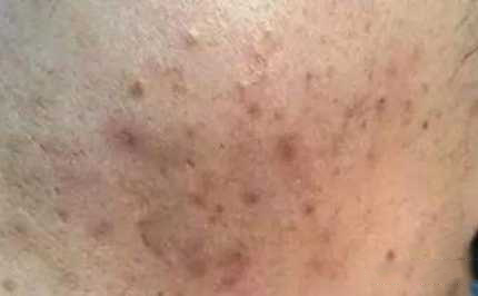 比较快速有效的祛痘印方法,教你一招快速祛痘印