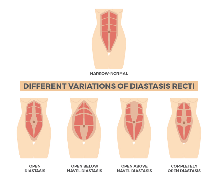 腹肌撕裂腹直肌分离,腹肌撕裂者腹直肌疼