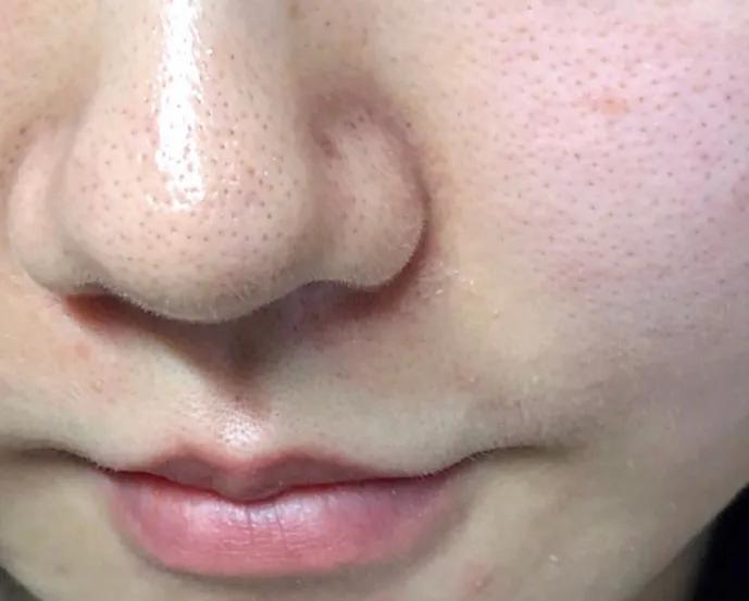 医美收毛孔价格表,医美收毛孔什么方法好