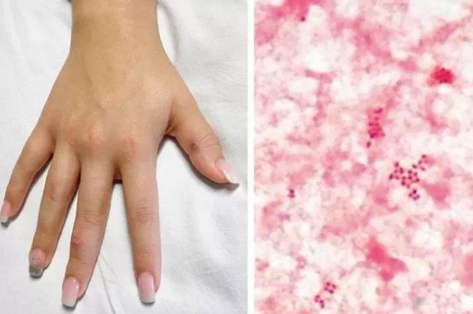 约炮软件流行加拿大某省性病大爆发