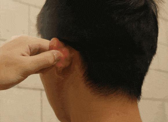 小耳畸形三期主要是做什么,大小耳畸形能好吗