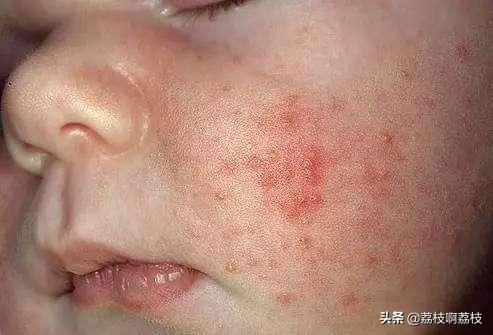 脸上痘痘爆脓怎么处理,小孩脸上痘痘怎么处理