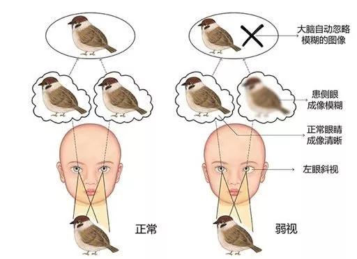 右眼弱视右眼斜视怎么治,弱视和斜视先治疗哪个