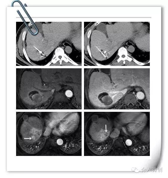肝癌门静脉癌栓能做介入手术吗,肝癌门静脉癌栓中医治疗