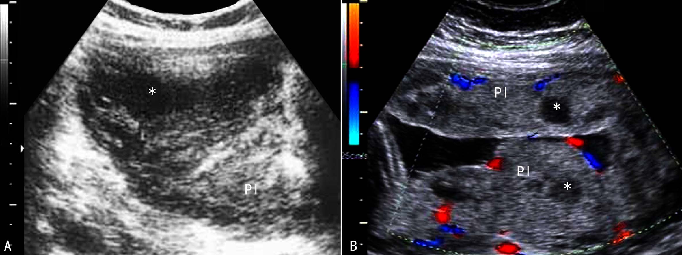 胎盘异常的超声表现,胎盘的异常超声