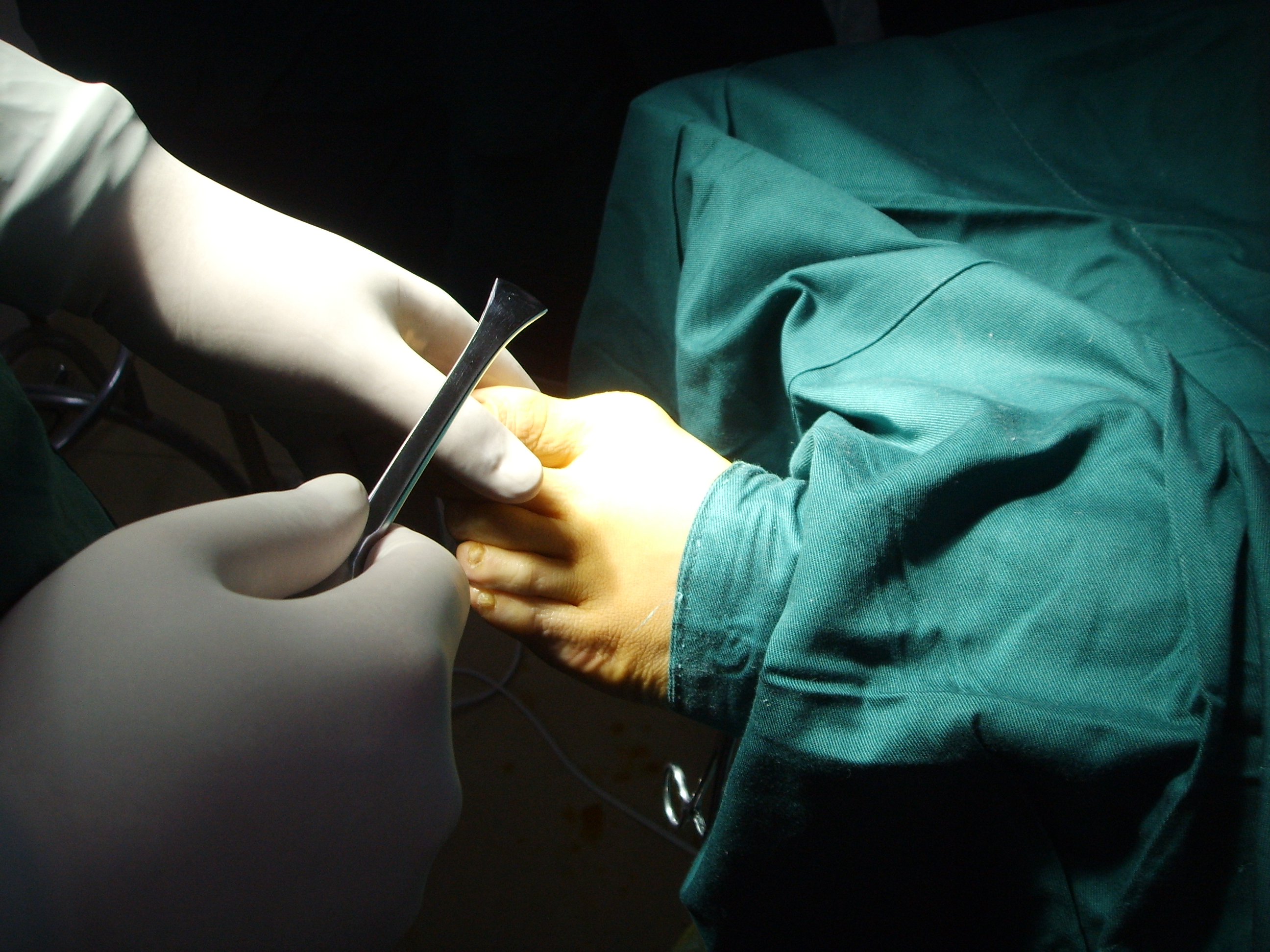 脚拇指外翻手术后还会遗传吗,遗传性拇外翻需要做手术么