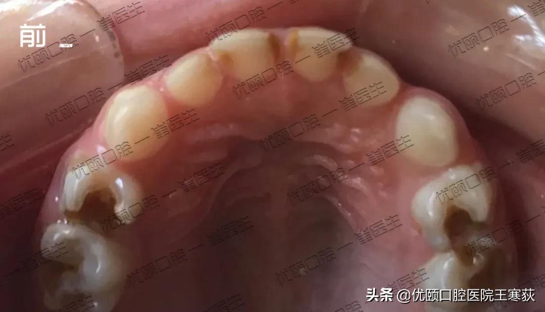 儿童全麻治疗过程,三岁宝宝根管治疗全麻有危害吗