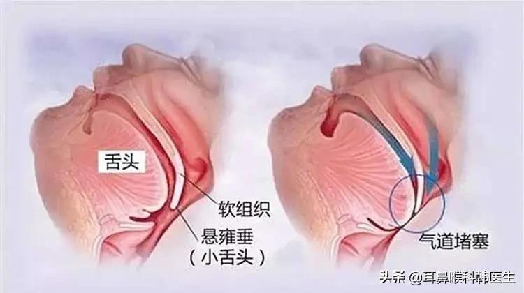 长期打呼噜呼吸不畅需要吸氧吗,长期打呼噜有什么好办法治疗