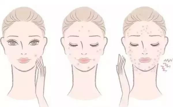 痘印反反复复怎么办,痘印一直反反复复怎么办