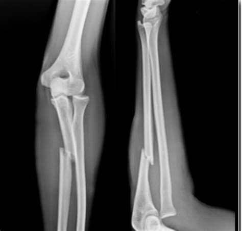 腰椎间盘突出针灸有副作用吗,腰椎间盘突出针灸越来越严重