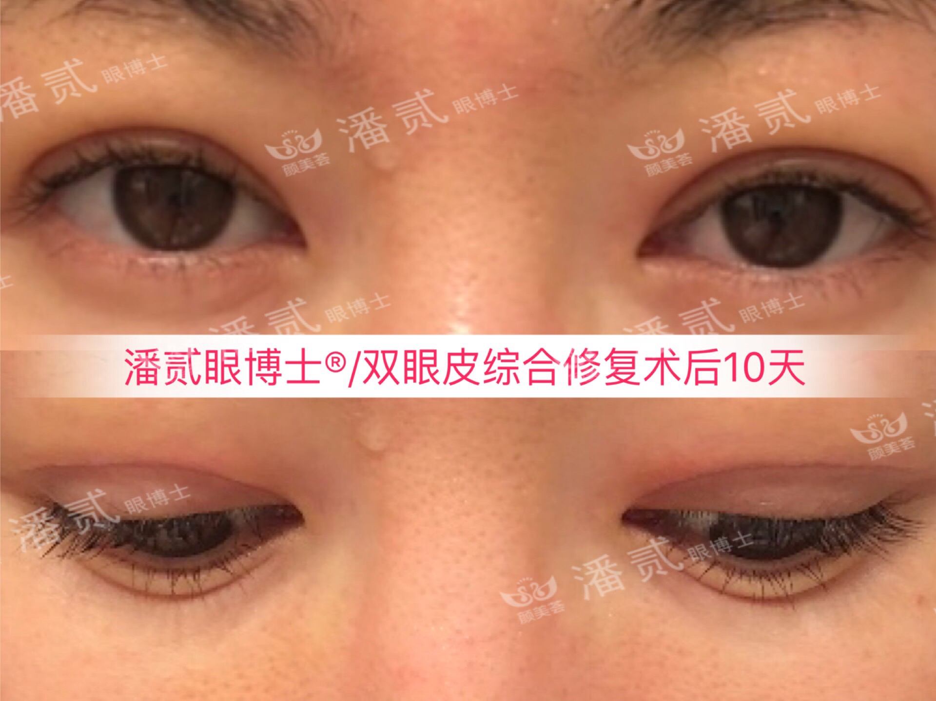 广州双眼皮修复内双,广州双眼皮修复可以只修眼尾吗