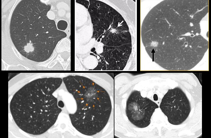 华西廖正银教授治肺结节,华西医院肺癌专家唐小军