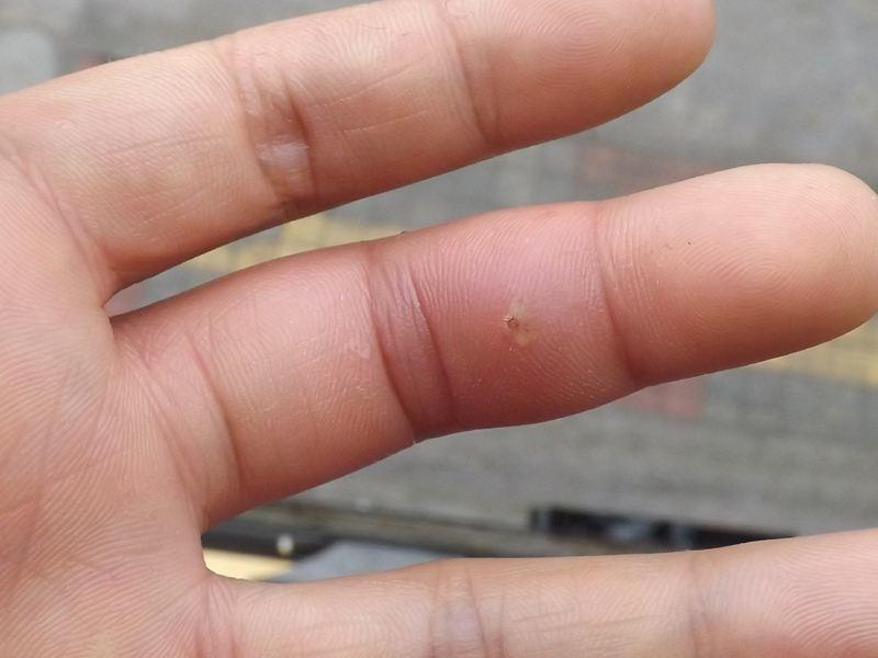 木刺扎到手指急救妙招,不小心把刺戳进手指里怎么办