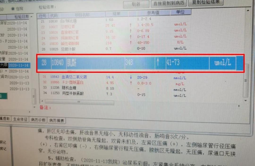 小结石3x3mm,3mm结石没感觉就出来了