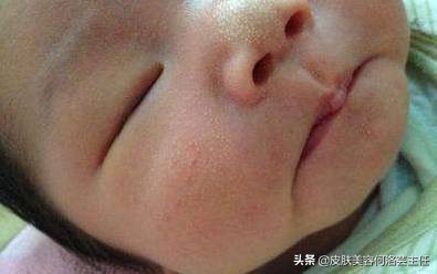 脂肪粒是怎么形成的怎样根除,脂肪粒是怎么形成的怎么处理