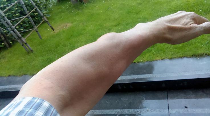 已有的脂肪瘤是不是不会消失,有很多脂肪瘤是不是癌症的征兆