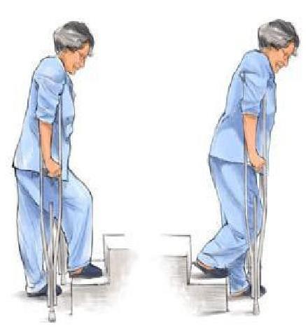 人工关节置换术后康复训练,股骨颈骨折人工置换术后康复训练