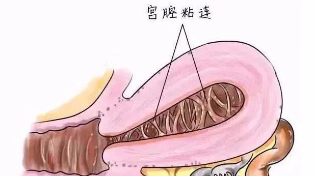 关爱女性|呵护子宫,不可忽视“宫腔粘连”