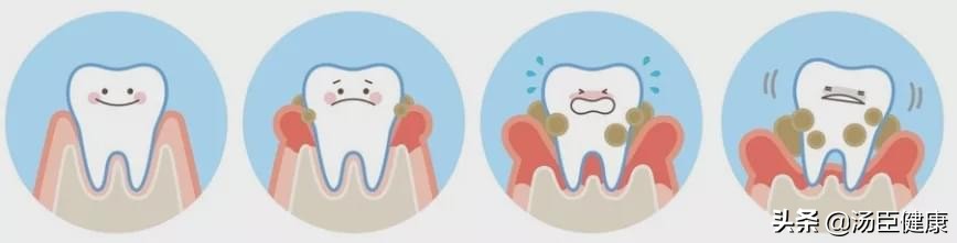 牙周炎很多人都有吗,牙周炎人人都有吗