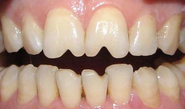 吃出“瓜子牙”，怎样才能恢复如初？