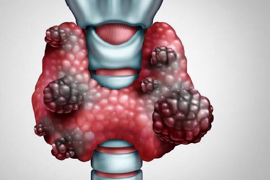 引起结节的三大原因,结节是什么原因造成的怎么治