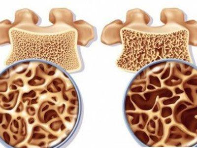 骨科专家细讲片子知识大全,骨科专家讲氨糖