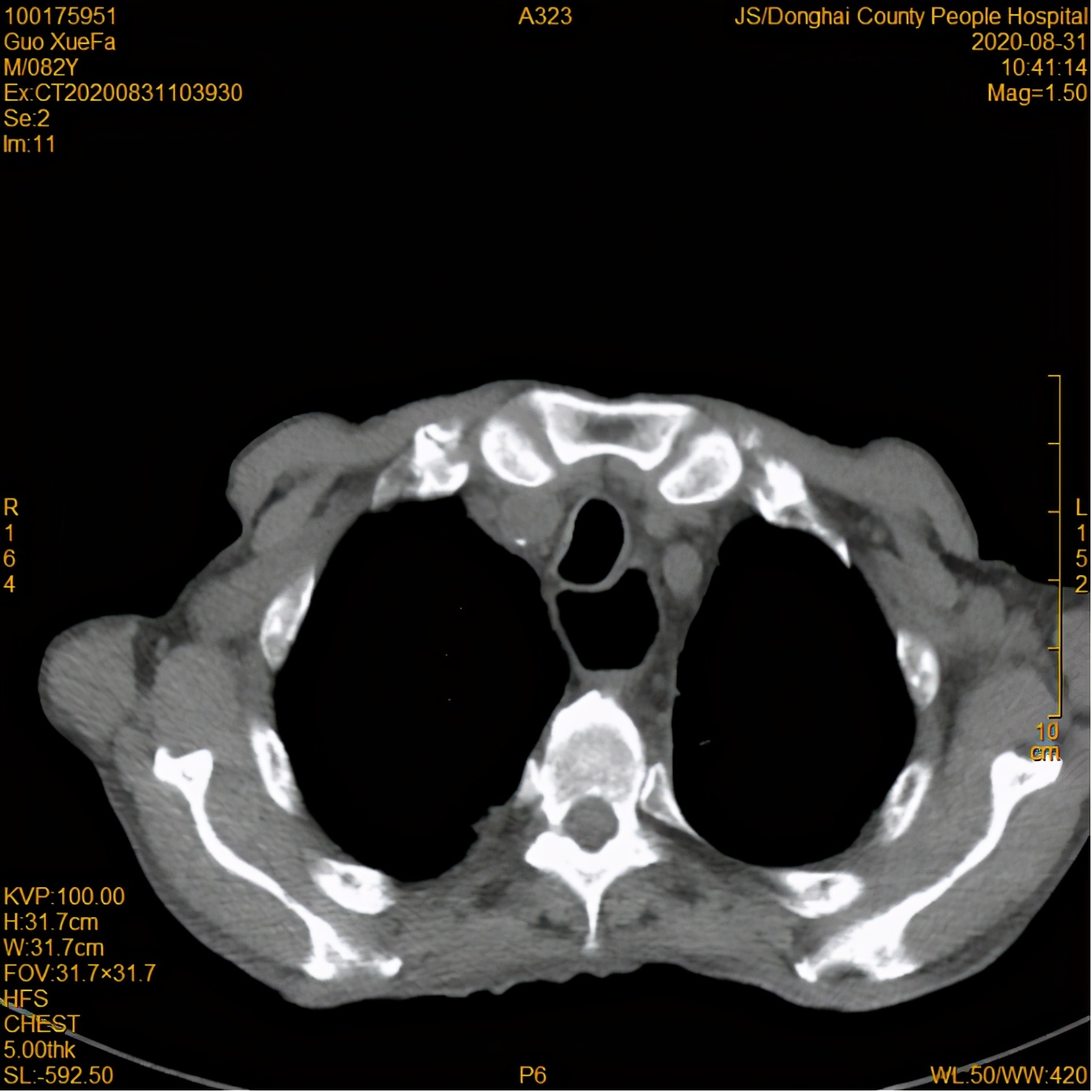 放疗后，82岁高龄食管癌患者情况好转