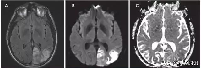 脑卒中病历诊断书图片,脑卒中影像判断技巧图解电子版