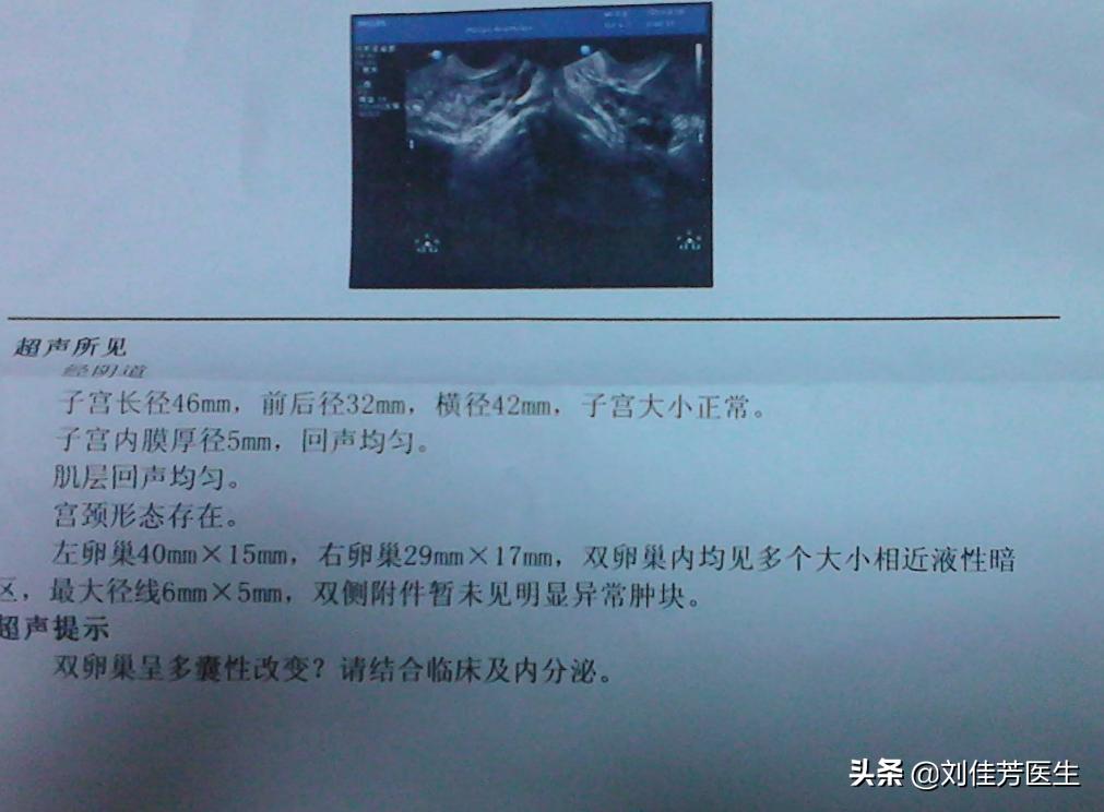 多囊是怎么诊断出来的,造成多囊的原因有哪些