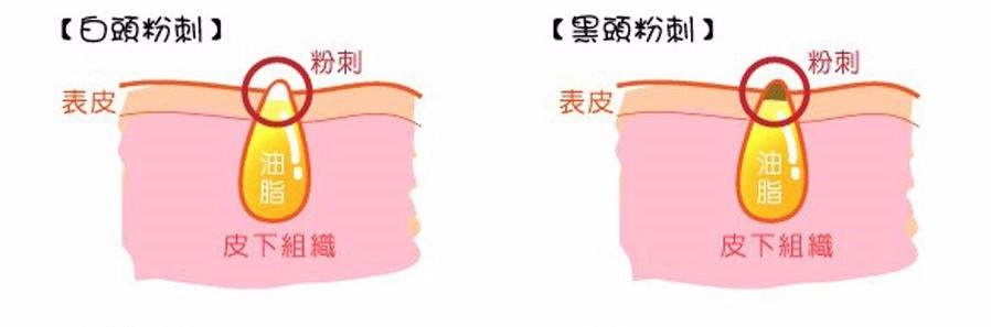 毛孔黑头小妙招,怎么改善毛孔粗大黑头闭口