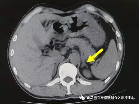 讲述一位高血压患者治愈经历,难治性高血压诊治图解