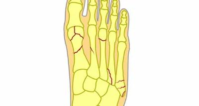 前脚掌疼痛,前足疼