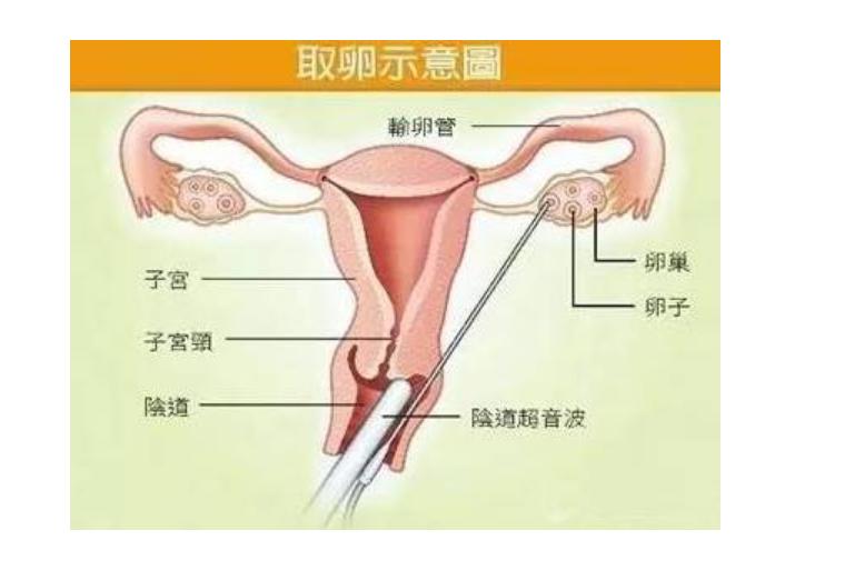 揭秘女性取卵全过程：明星代孕的背后，到底有多恐怖？