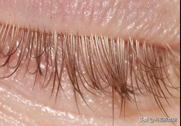 是真的吗螨虫可以导致脸上长痘痘,脸上长痘痘有螨虫怎么办