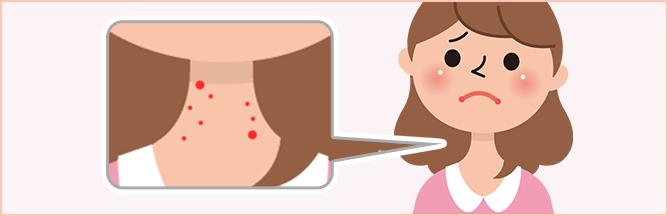 暗疮最好的消除方法 (暗疮印最佳治疗方法)