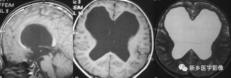 影像学脑室扩大,脑室显大怎么理解