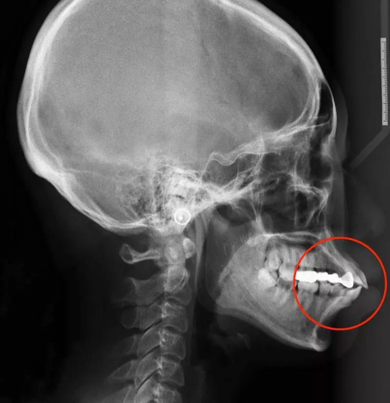 嘴突真的很影响颜值吗,被嘴凸影响的颜值