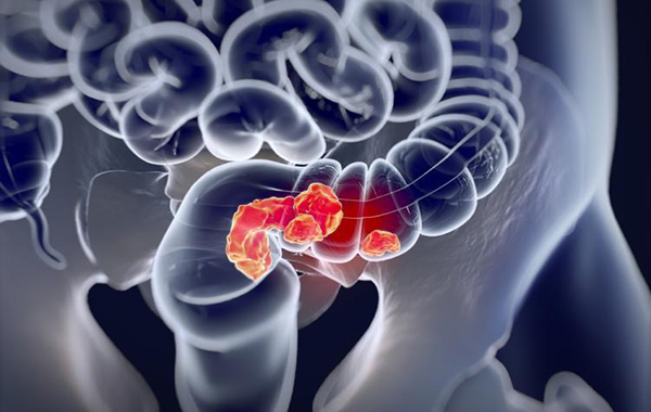便血就一定是肠癌吗,便血有点暗红是癌吗