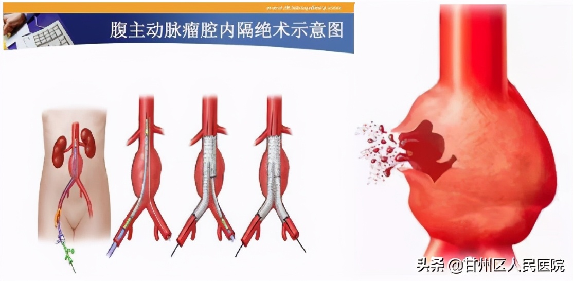 腹主动脉瘤微创手术哪里能做,腹主动脉瘤35毫米做了手术